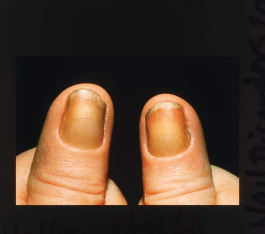 Under the Microscope: Yellow Nail Syndrome