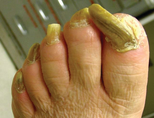 Under the Microscope: Onychogryphosis