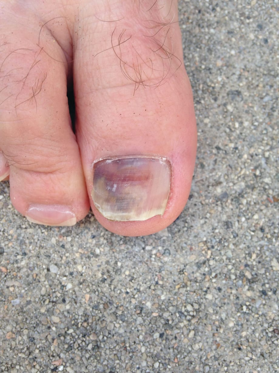 A Day in the Life of a Nail Expert: Subungual Hematoma