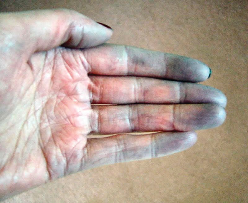 Under the Microscope: Raynaud’s Syndrome