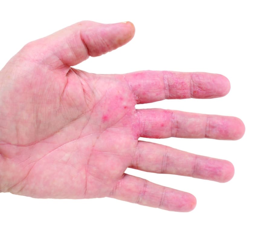 Something to Talk About: Eczema