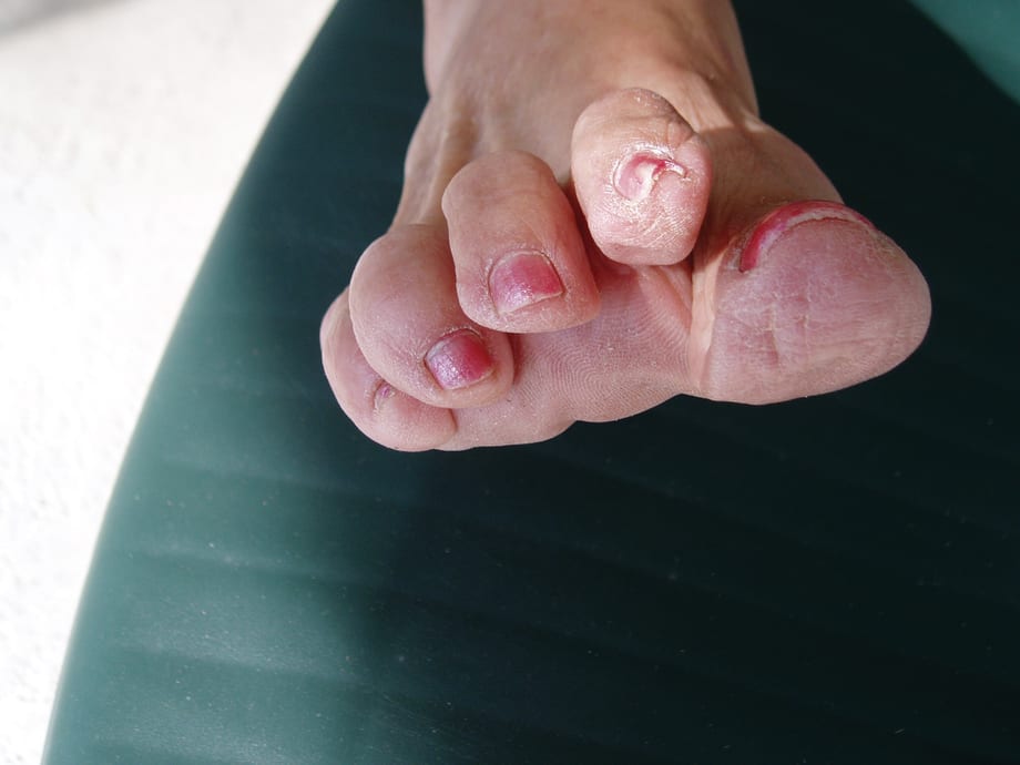 Prevent Pincer Nails