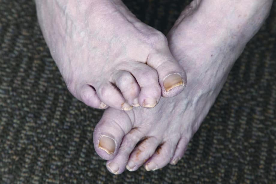 Under the Microscope: Hammertoe