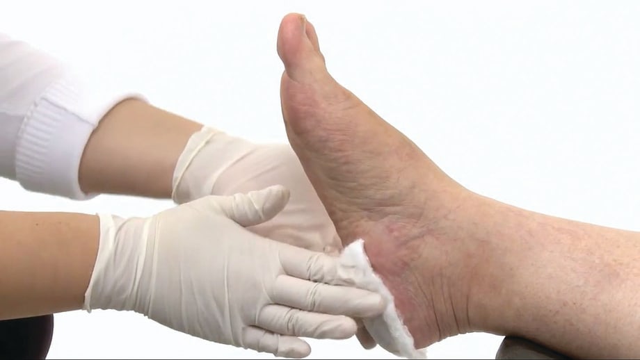 Safe, Gentle Callus and Cuticle Removal