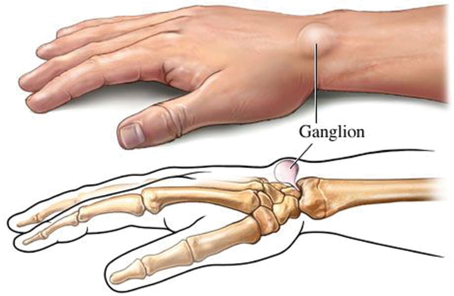 Personal Trainer: Ganglion Cysts