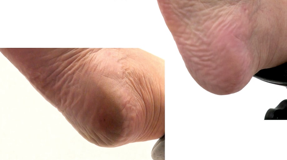 How to Use PodoSafe Callus Remover