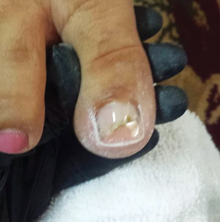 Correcting Toenail Issues — From Stubbed Toes to Total Reconstruction