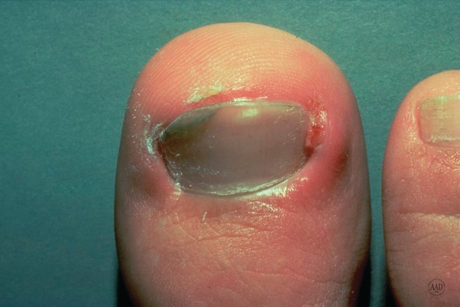 Know Your Onychos: A Nail Disease Quiz