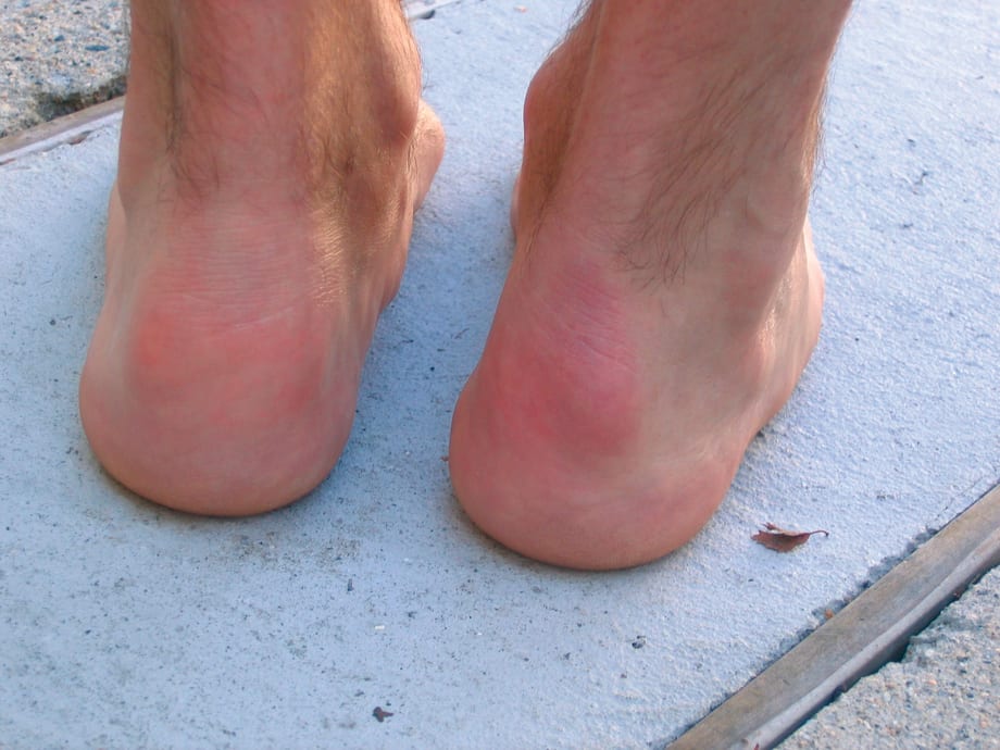 What Is Haglund's Deformity?