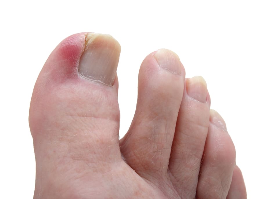 Under the Microscope: Ingrown Toenails