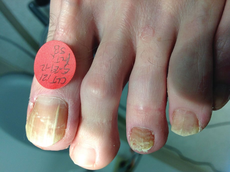 Treating Fungus With Lasers