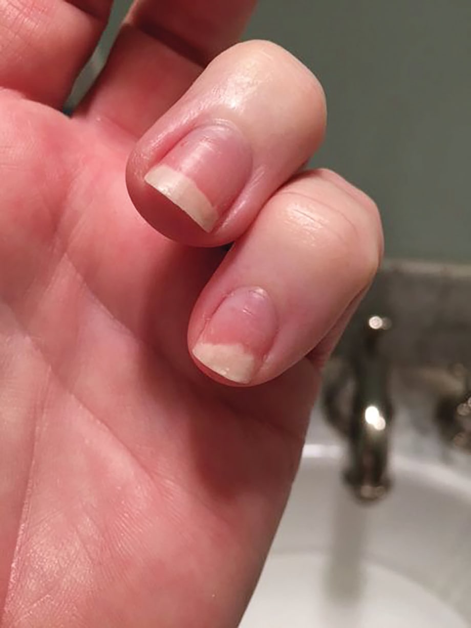 Something to Talk About: Onycholysis