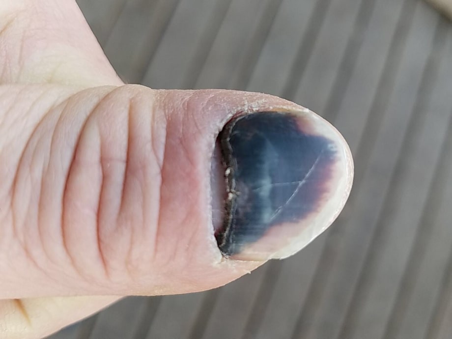 Documenting a Nail Regrowing