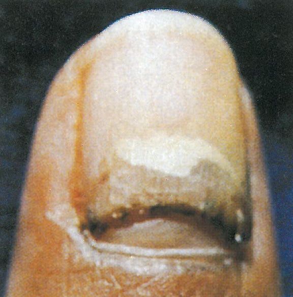 The Nail Doctor on Injured Nails
