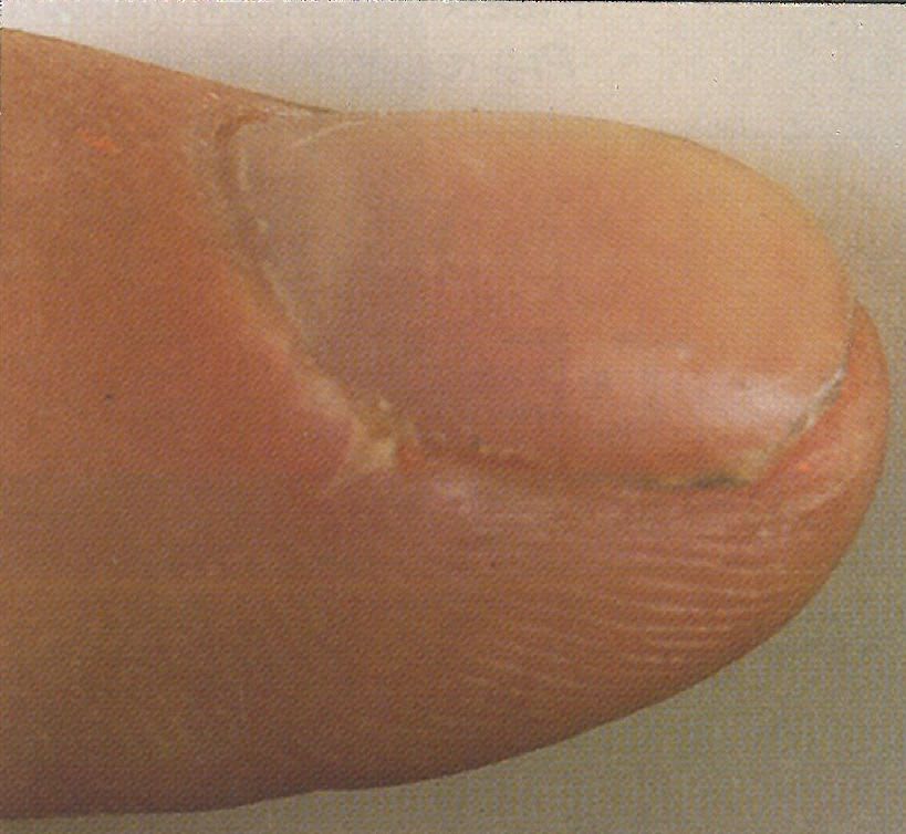 The Nail Doctor: Some Clients Shouldn’t Wear Acrylics