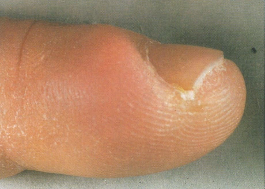 Don't Ignore Minor Infections