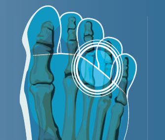 Under the Microscope: Neuromas