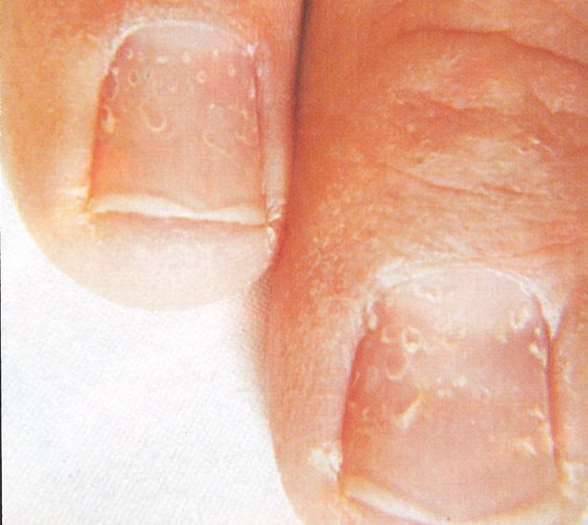 Nutrition and Nails