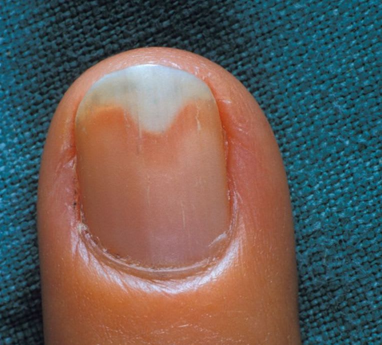 What Is Onycholysis?