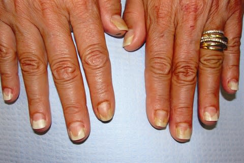 The Nail Doctor: Onycholysis, or Nail Separation, Has Different Varieties