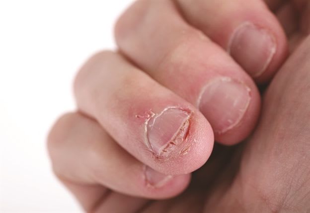 What Is Onychophagy (Badly Bitten Nails)?