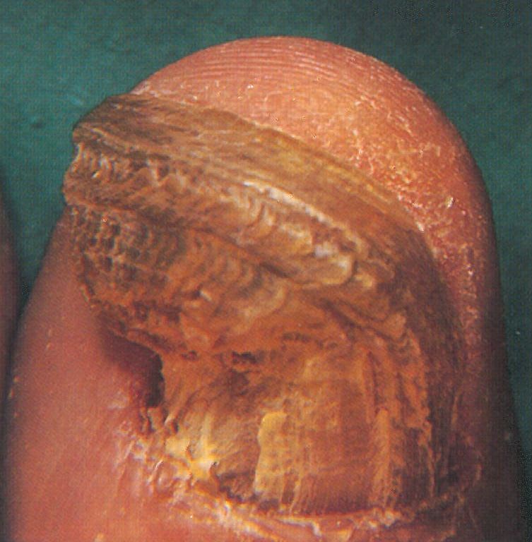 Onychogryphosis Can Be Helped in the Salon