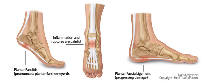 What Is Plantar Fasciitis?