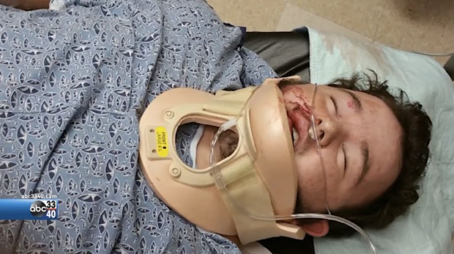 Video: Mother Says Alabama Teen Severely Beaten for Supporting Police