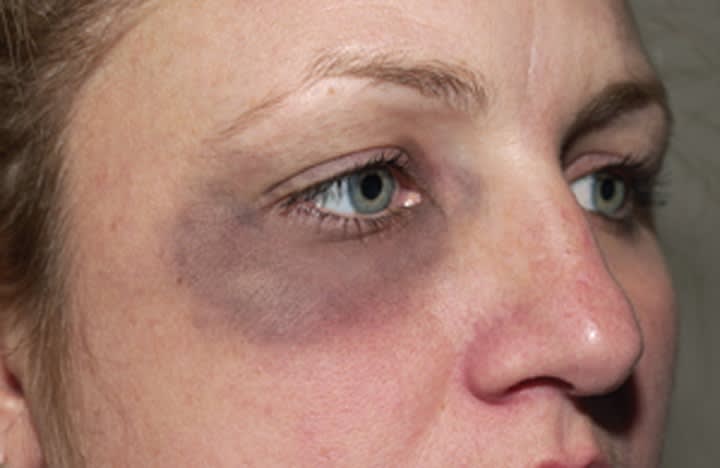 How to Photograph Injuries