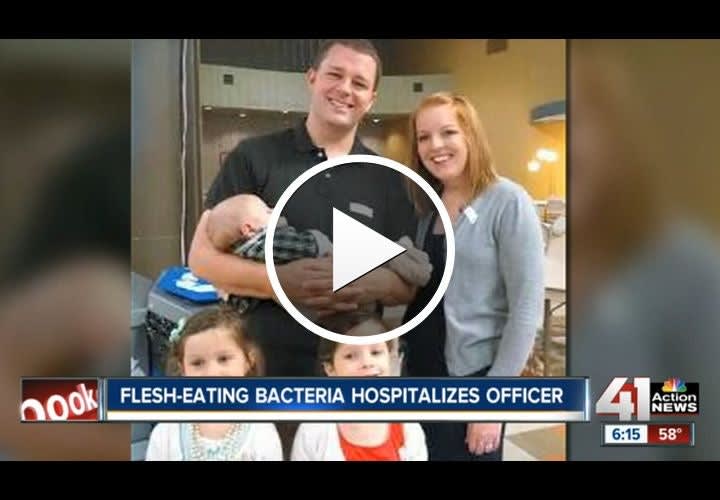 Video: Flesh-Eating Bacteria Hospitalizes Missouri Officer