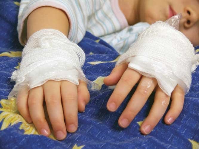 Child Burn Investigations