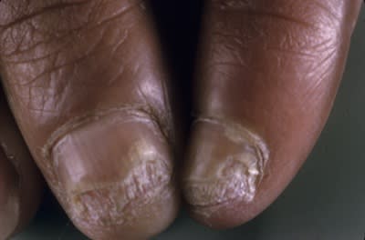 The Nail Doctor: Grooved Nails and Lifted Plates