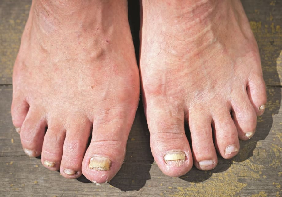 Something to Talk About: Ringworm