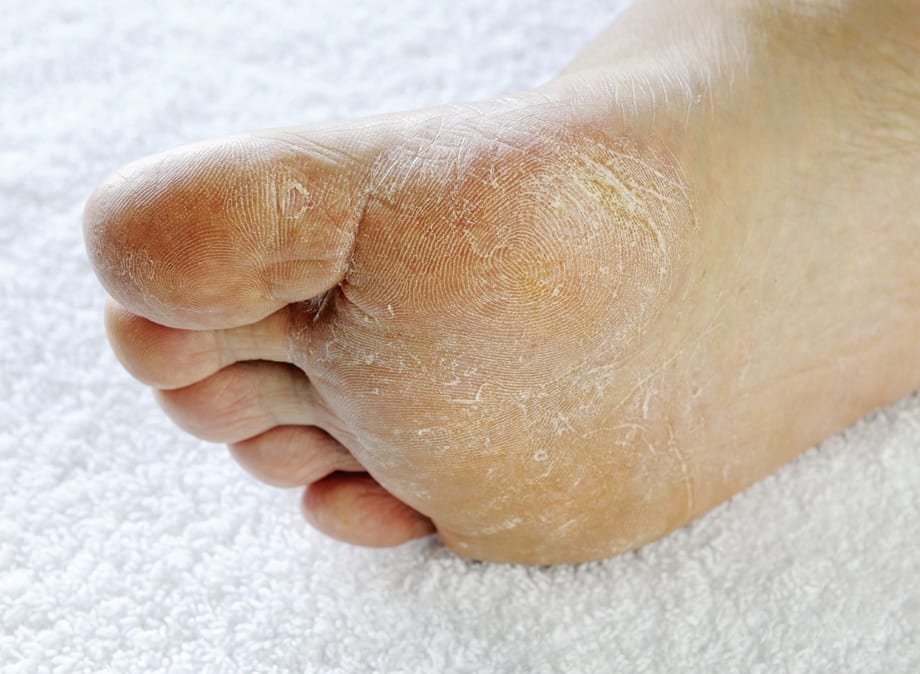 Something to Talk About: Athlete’s Foot
