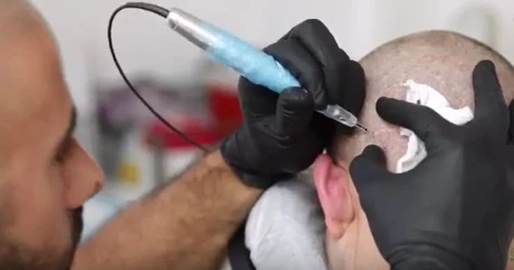 Scalp Micropigmentation: Masking Scars, Creating a Hairline, Restoring Confidence