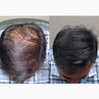 Before and Afters with SureThik Hair Thickening Fibers