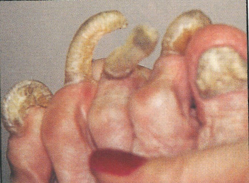 Regular Maintenance Can Prevent Nail Thickening