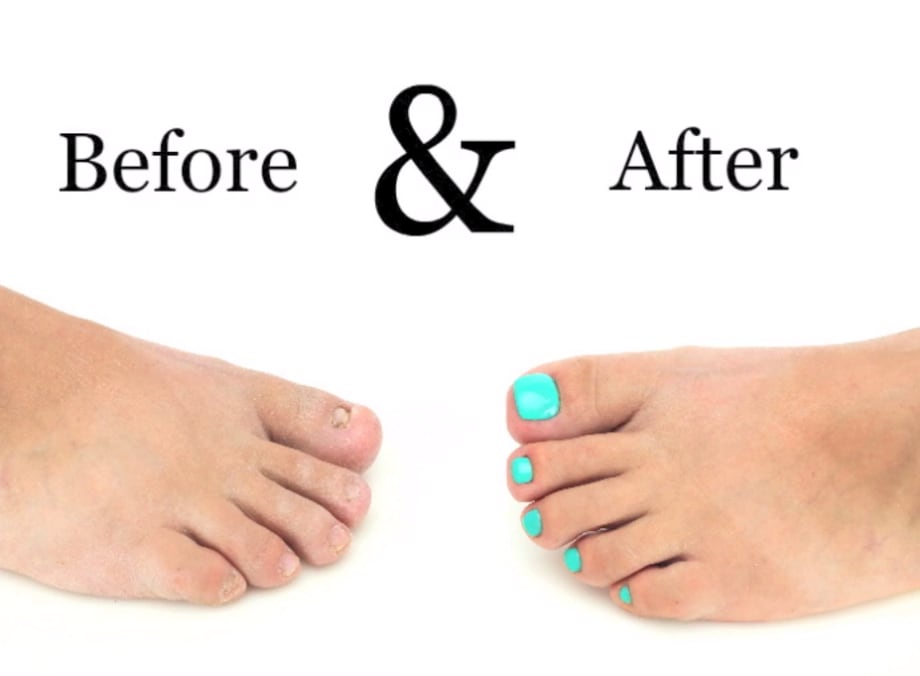 Toenail Reconstruction with Gel