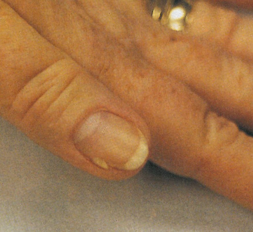 Troubleshooter: Protecting and Reinforcing a Split Nail