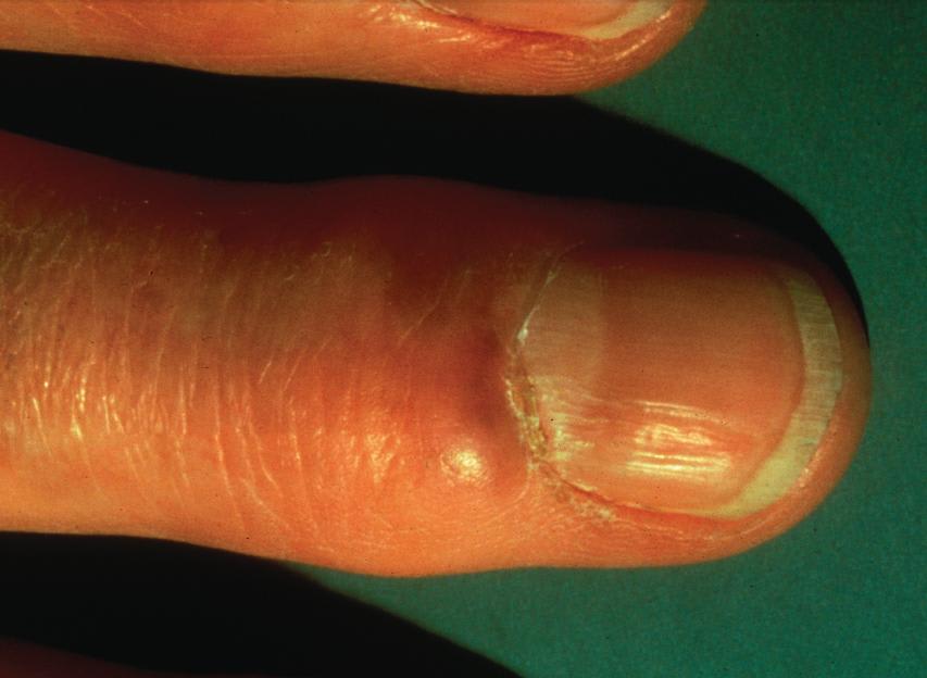 Myxoid Cysts