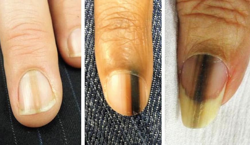 A Day in the Life of a Nail Expert: Melanoma