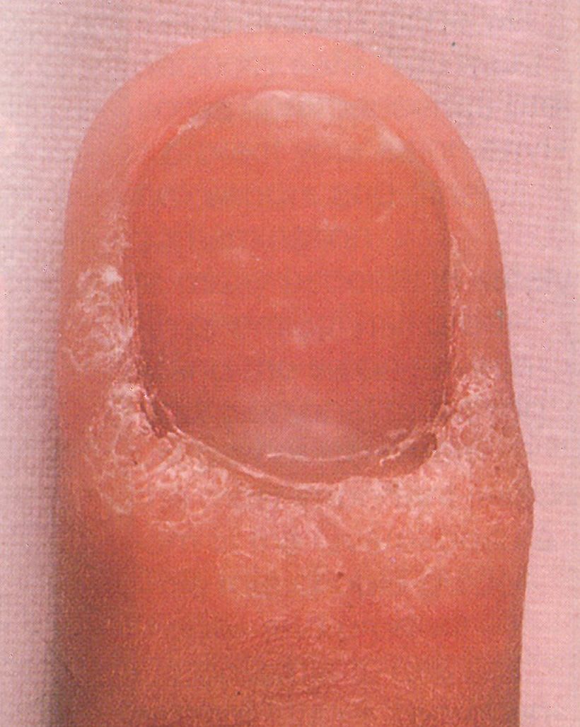 The Nail Doctor: Avoid Spreading Warts Viruses